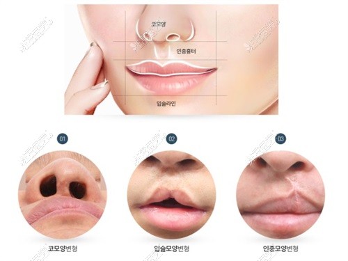韩国唇腭裂做的好吗?这有几家可以做唇腭裂修复好的医院!