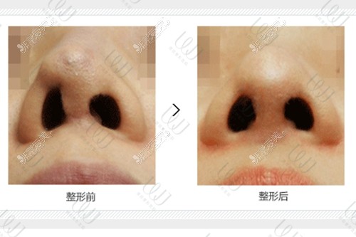 韩国整鼻子出名的医院WJ原辰上榜,鼻整形鼻修复被认可!