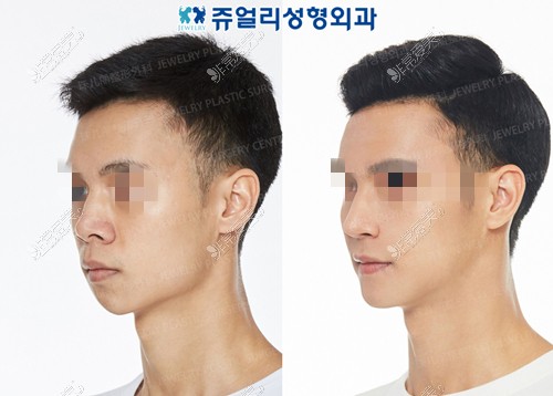 韩国珠儿丽整形外科男士隆鼻对比图