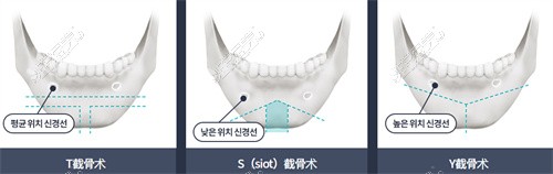 韩国李相均下巴手术示意图