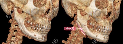 韩国DA整形外科轮廓修复手术