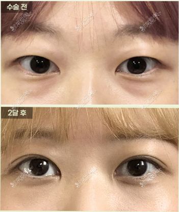 韩国乐日整形眼部手术前后图