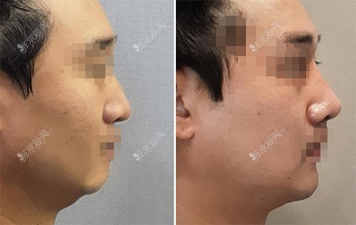 韩国温度整形外科轮廓定制鼻子术前术后对比