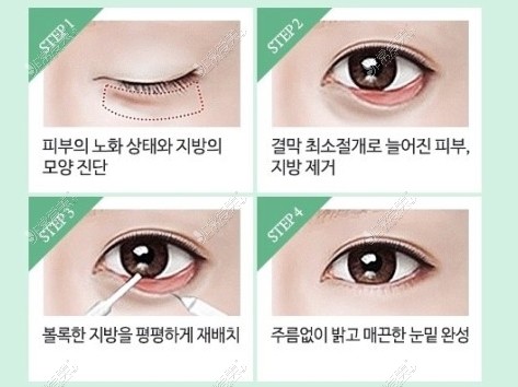 韩国必妩整形医院眼袋手术过程