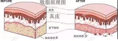 吸脂手术原理图解