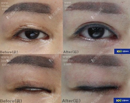 韩国IOU整形外科双眼皮修复