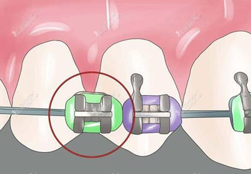 金属自锁正畸改善