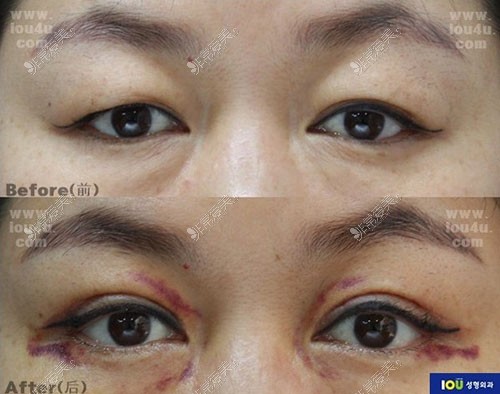 韩国IOU整形外科双眼皮修复