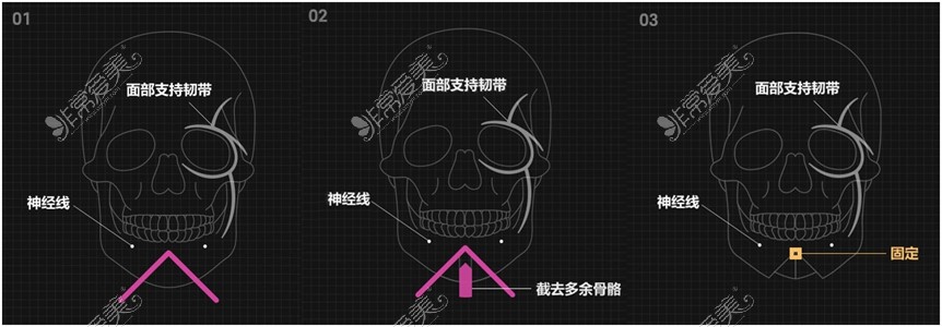 韩国WJ原辰面部轮廓综合手术分析,实现真正的V-line脸型!