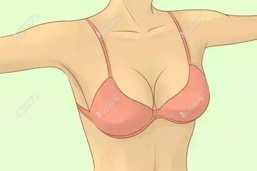 隆胸手术展示图