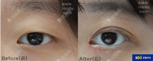 韩国iou整形眼部手术前后照片