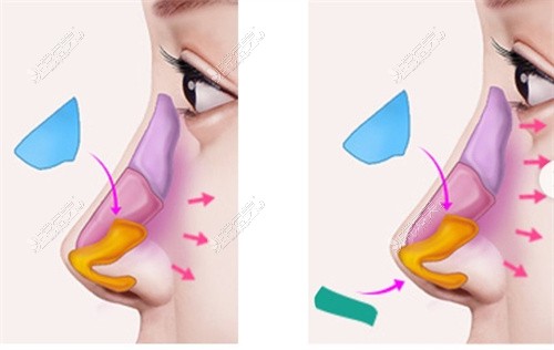 隆鼻前后对比图
