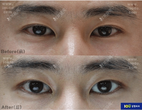 韩国iou整形的双眼皮改单眼皮前后照片
