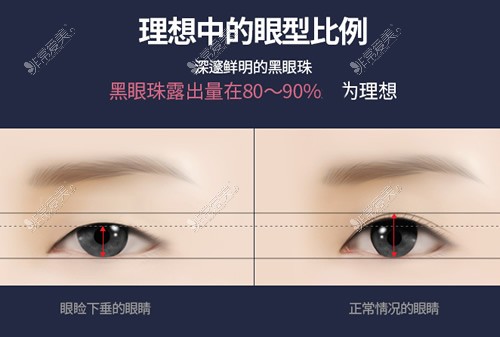 韩国欧佩拉整形双眼皮整形比例展示