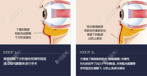 韩国欧佩拉整形双眼皮手术原理分析