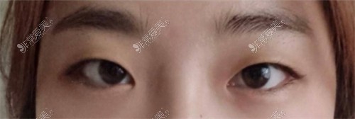 韩国欧艾尔ONAIR整形外科眼型矫正术前