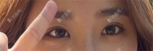 韩国欧艾尔ONAIR整形外科眼型矫正术后