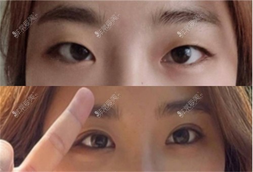 韩国欧艾尔ONAIR整形外科眼型矫正对比图