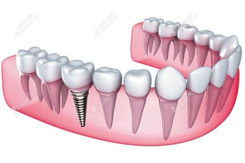 种植牙示意图