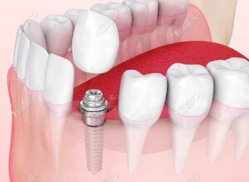 牙齿种植3D图示