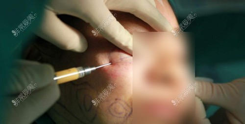 面部填充手术过程图