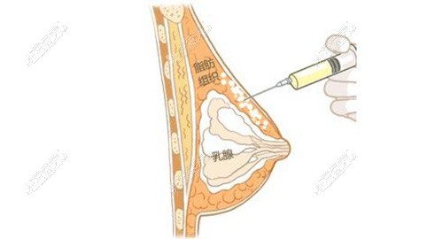 脂肪丰胸示意图