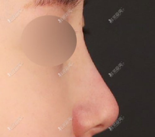 三组真人实例解析韩国TS整形外科做鼻子的优点！