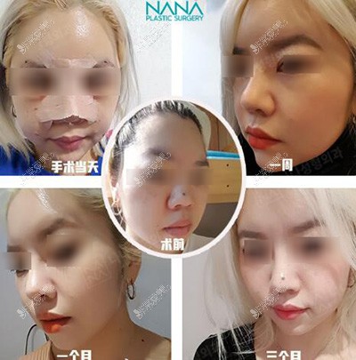 韩国娜娜整形外科隆鼻照片