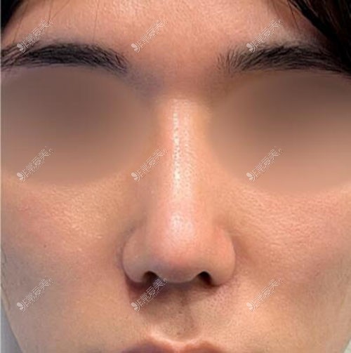 韩国乐日lara整形外科鼻整形术后