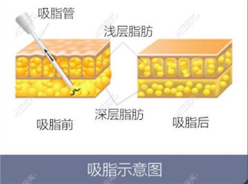 吸脂示意图