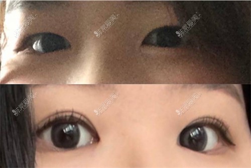 欧艾尔ONAIR整形外科眼型矫正对比