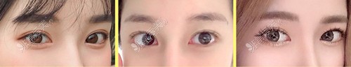 韩国da整形不同风格的眼部整形手术照片