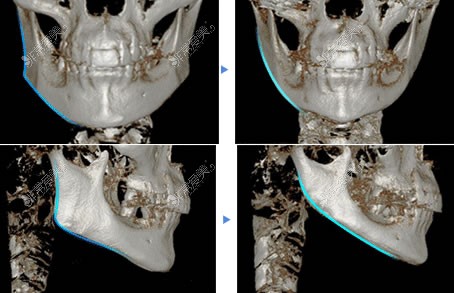 韩国4月31日整形外科下颌角截骨前后CT对比