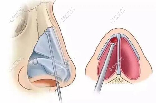 鼻改善治疗展示图