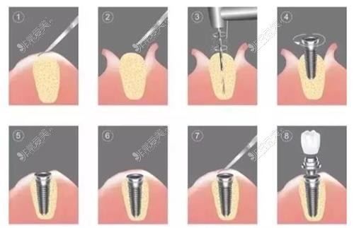 种植牙示意图
