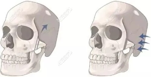 颧骨手术展示图