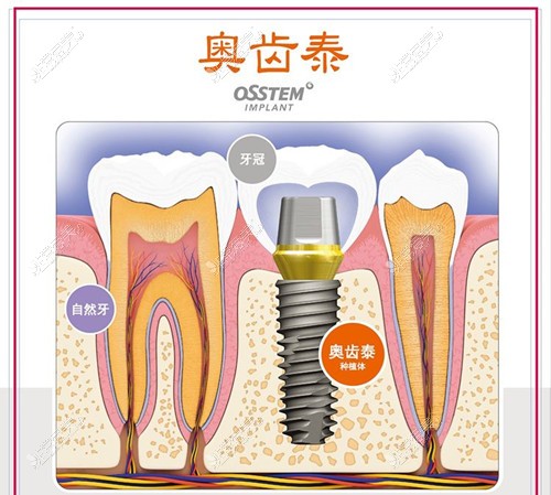 韓國奧齒泰種植牙