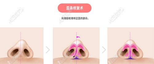 韩国VG百利酷整形外科自体肋软骨歪鼻矫正