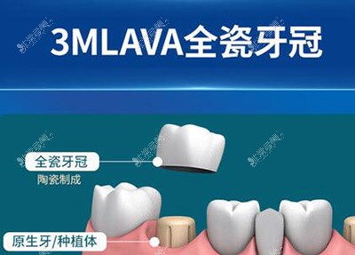 全瓷牙冠材料圖