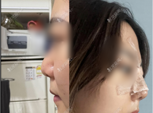 来自在韩国温度整形外科,顾客做鼻子术前术后亲身经历分享