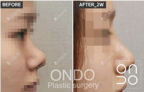 来自在韩国温度整形外科,顾客做鼻子术前术后亲身经历分享
