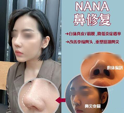 韩国哪个医生做鼻子修复好看?排行榜前五医生值得了解下!