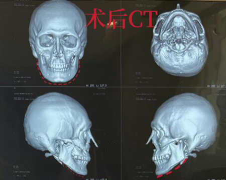 柳超磨骨术后CT展示