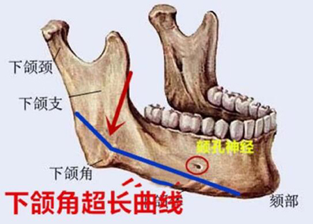 下頜角截骨卡通展示圖