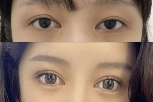 韩国双眼皮修复病例对比图合集,快种草韩国好的眼修复医院