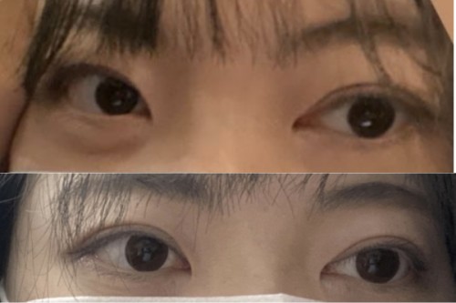 韩国EH爱护整形外科眼修复术前术后