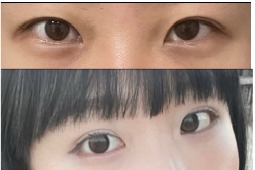 韩国迪美整形外科眼修复术前术后