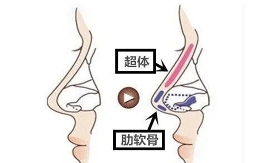 半肋隆鼻