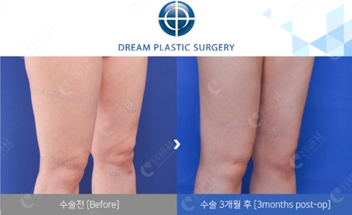 韩国梦想大腿吸脂术前术后对比