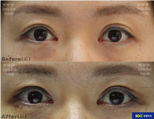 韩国iou整形双眼皮修复前后图